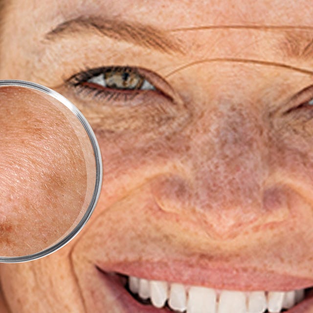 Derma_zonnebrand_afbeelding.jpg Derma_zonnebrand_afbeelding.jpg