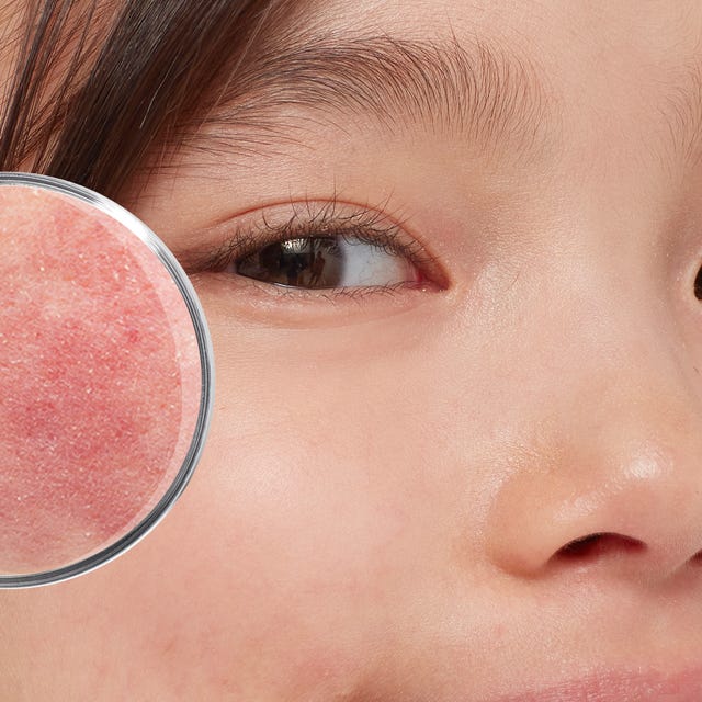 Derma_geirriteerde_rode_huid_afbeelding.png Derma_geirriteerde_rode_huid_afbeelding.png