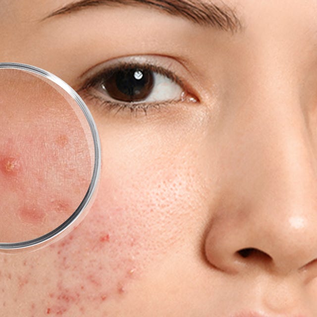 Derma_acne_afbeelding.png Derma_acne_afbeelding.png